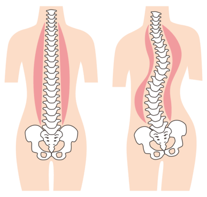 背骨が曲がっている原因と症状