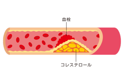 コレステロール値が高いと起きる症状や病気