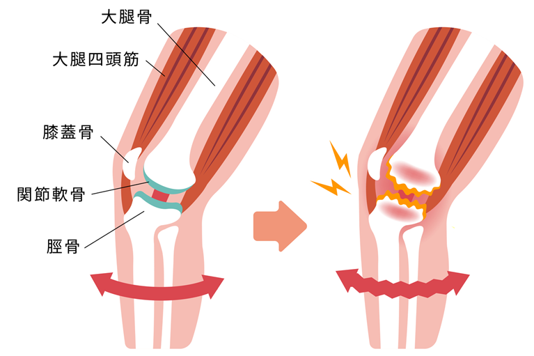 変形性膝関節症とは