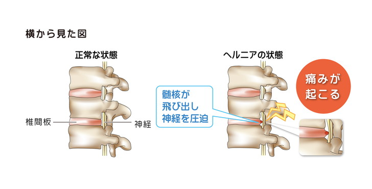 腰椎椎間板ヘルニアとは