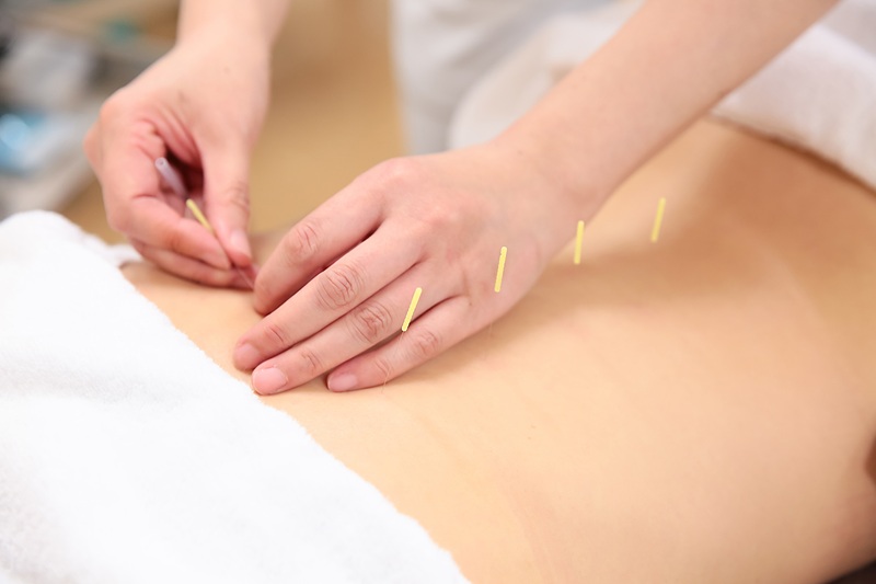 鍼灸治療